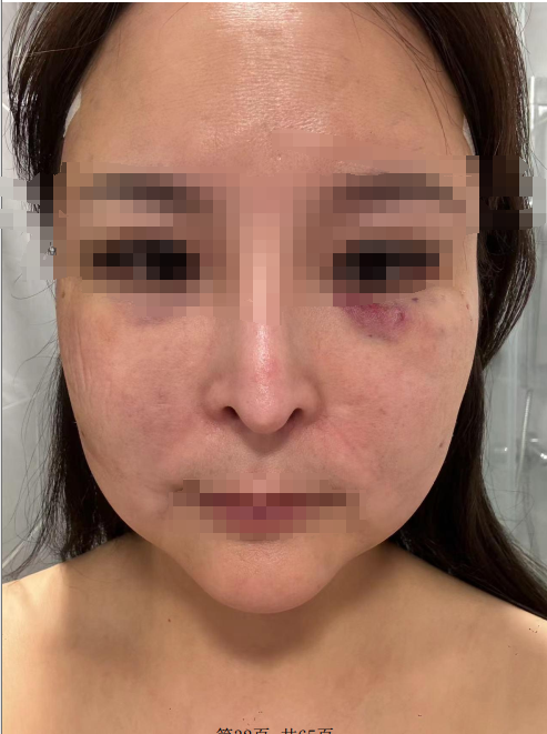 美容竟变毁容!女子打完美容针后面部出现硬块、红肿甚至溃烂;记者暗访调查:多人中招涉事产品根本不能用于注射但仍在销售(图2)