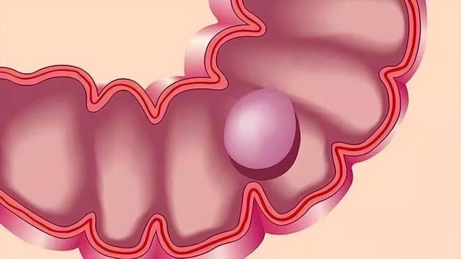 开云电竞有没有肠息肉上厕所就知道？肠道有息肉的人上厕所或有8异常(图7)